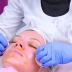 What is the strongest chemical skin peel?