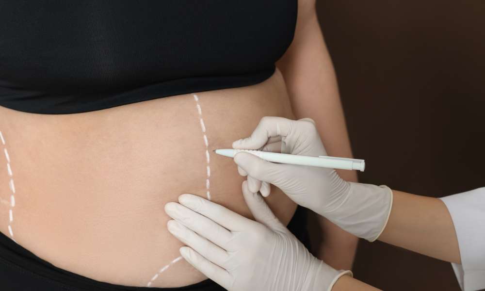 How Many Sessions For Liquid Liposuction?