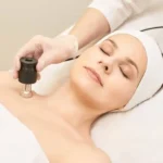 Microneedling with RF