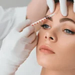 Microneedling with RF