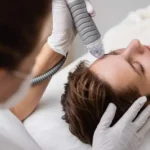 Microneedling with RF