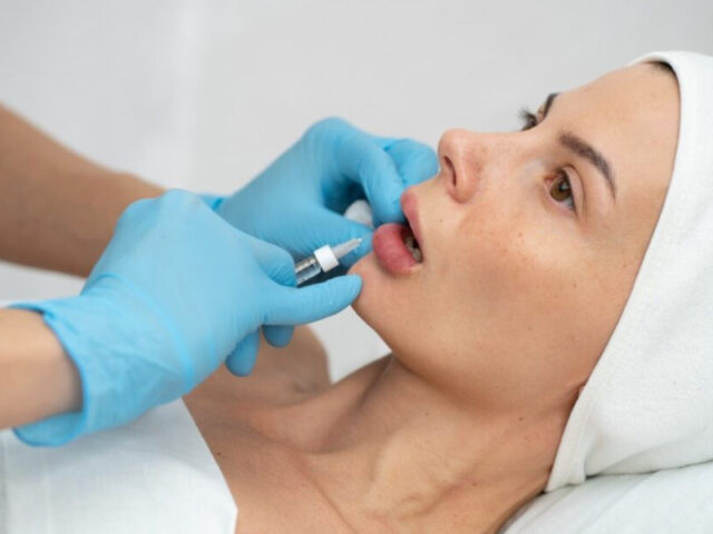 How Long Do Lip Fillers Last? Everything You Need to Know Before Getting Them