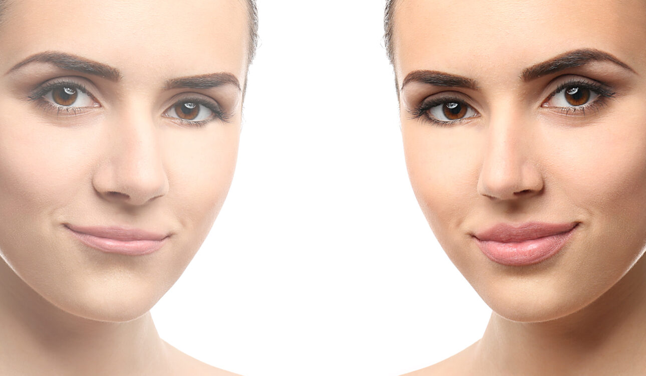 Natural Botox results in Maryville TN for refreshed look