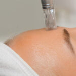 RF microneedling treatment process being performed in a clinical setting