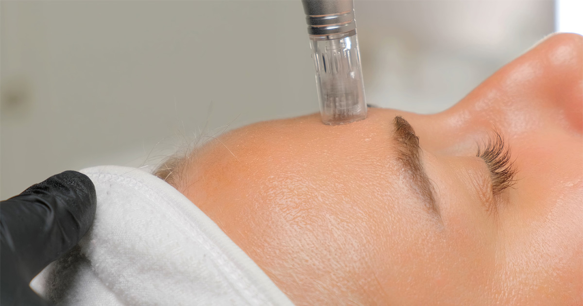 RF microneedling treatment process being performed in a clinical setting