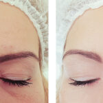Subtle before and after results of botox injections showing smoother forehead lines