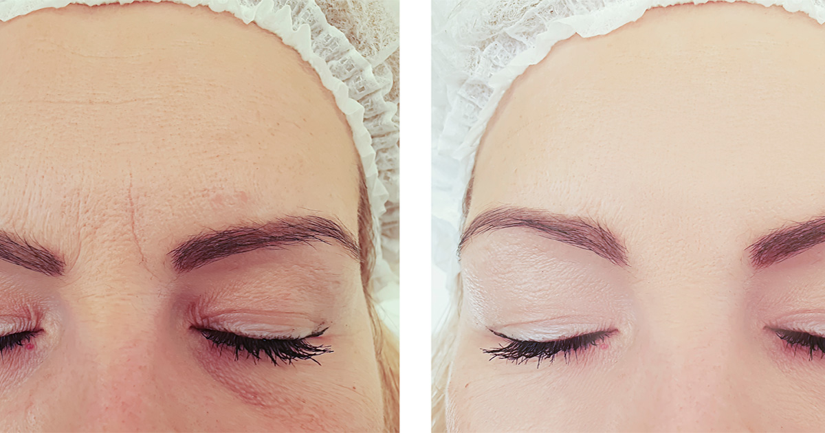 Subtle before and after results of botox injections showing smoother forehead lines