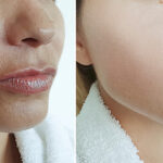 Botox treatment for wrinkles showing smoother skin and reduced fine lines