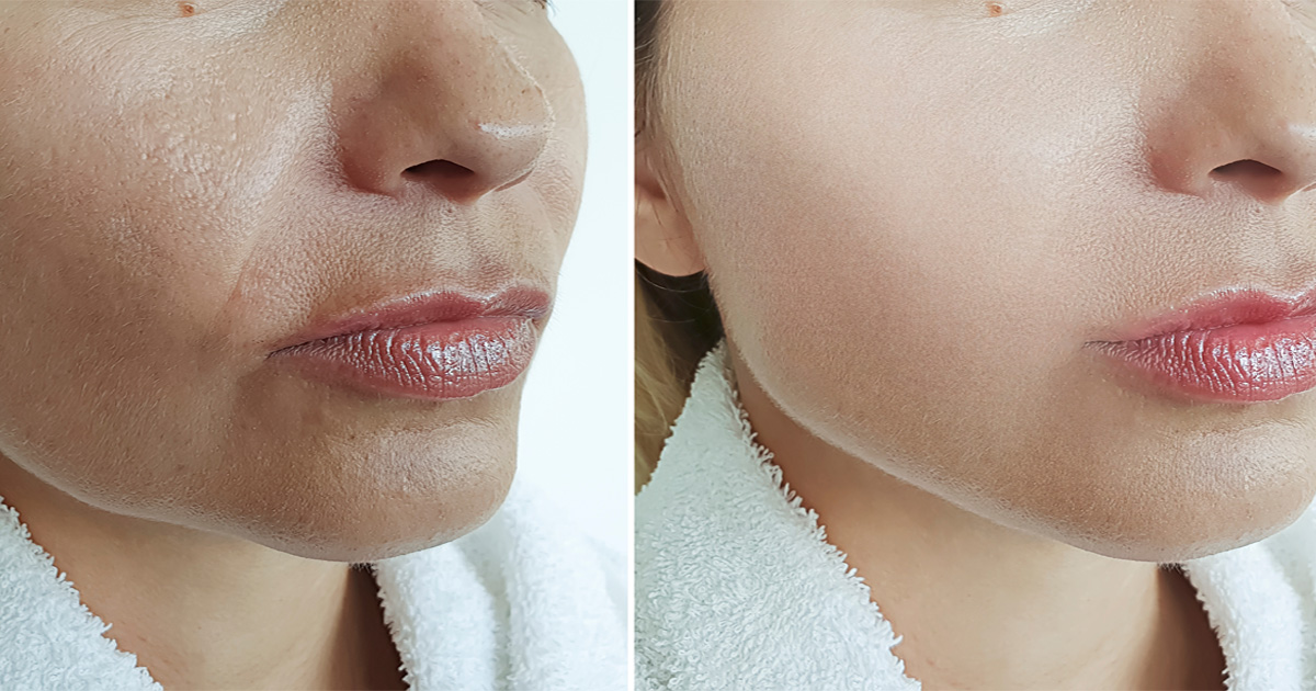 Botox treatment for wrinkles showing smoother skin and reduced fine lines