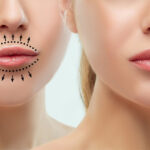 Lip fillers healing stages showing swelling and recovery timeline day by day