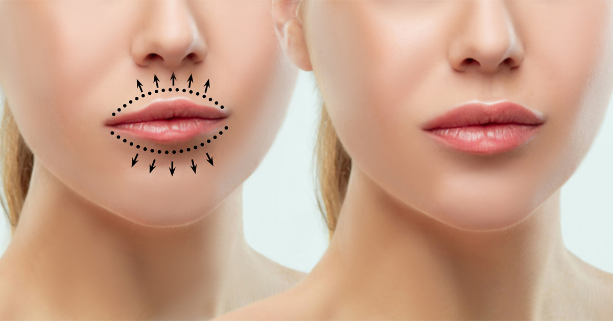 Lip fillers healing stages showing swelling and recovery timeline day by day