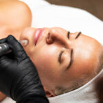 Radiofrequency microneedling treatment for skin tightening and collagen improvement