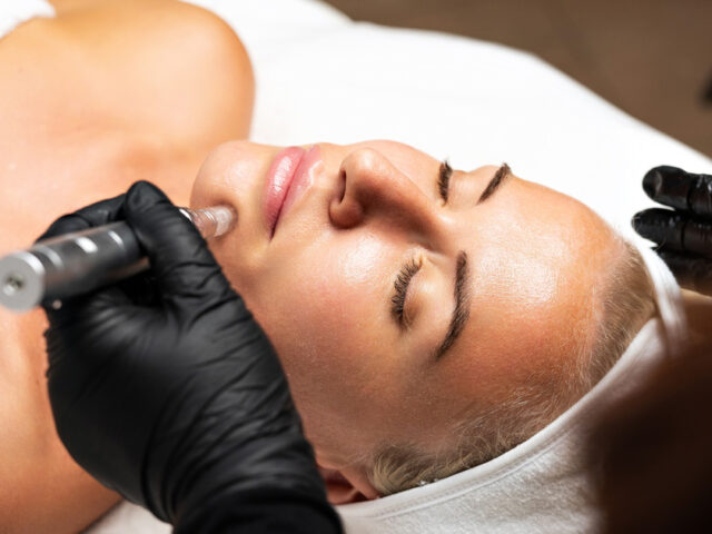 What Is Radiofrequency Microneedling and How Does It Work for Skin Tightening?