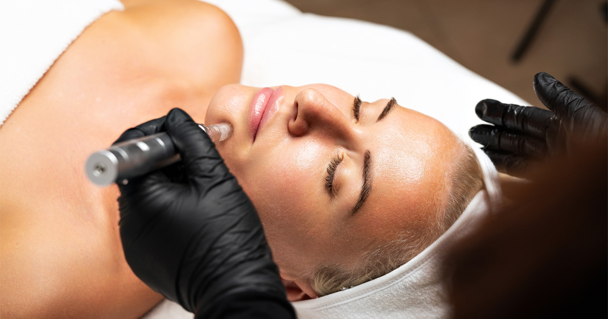 Radiofrequency microneedling treatment for skin tightening and collagen improvement