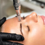 RF microneedling treatment improving skin texture through collagen stimulation