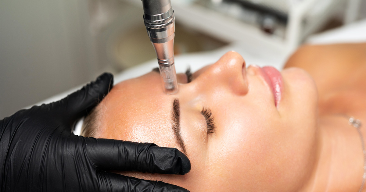 RF microneedling treatment improving skin texture through collagen stimulation