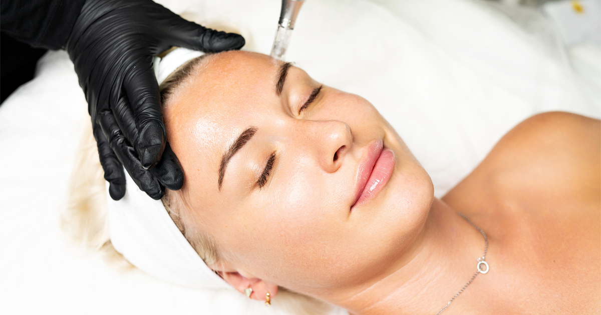 RF Microneedling in Alcoa TN