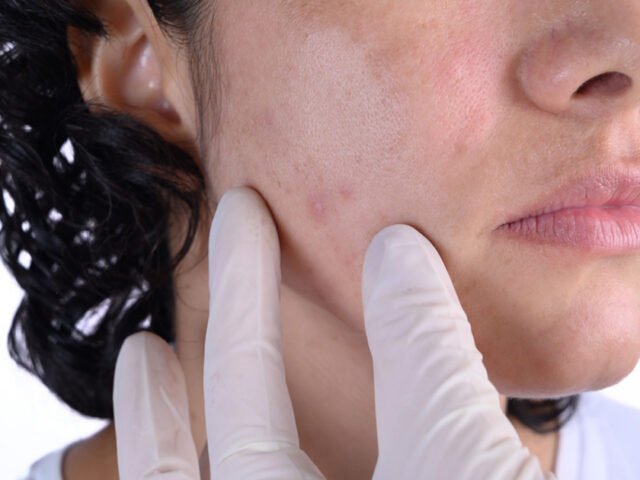 Can RF Microneedling Help Improve Acne Scars?