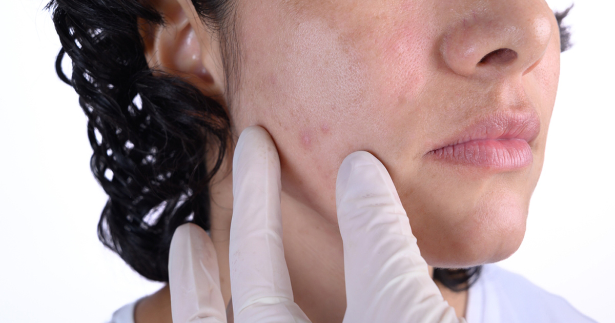 RF Microneedling for Acne Scars treatment for uneven skin texture