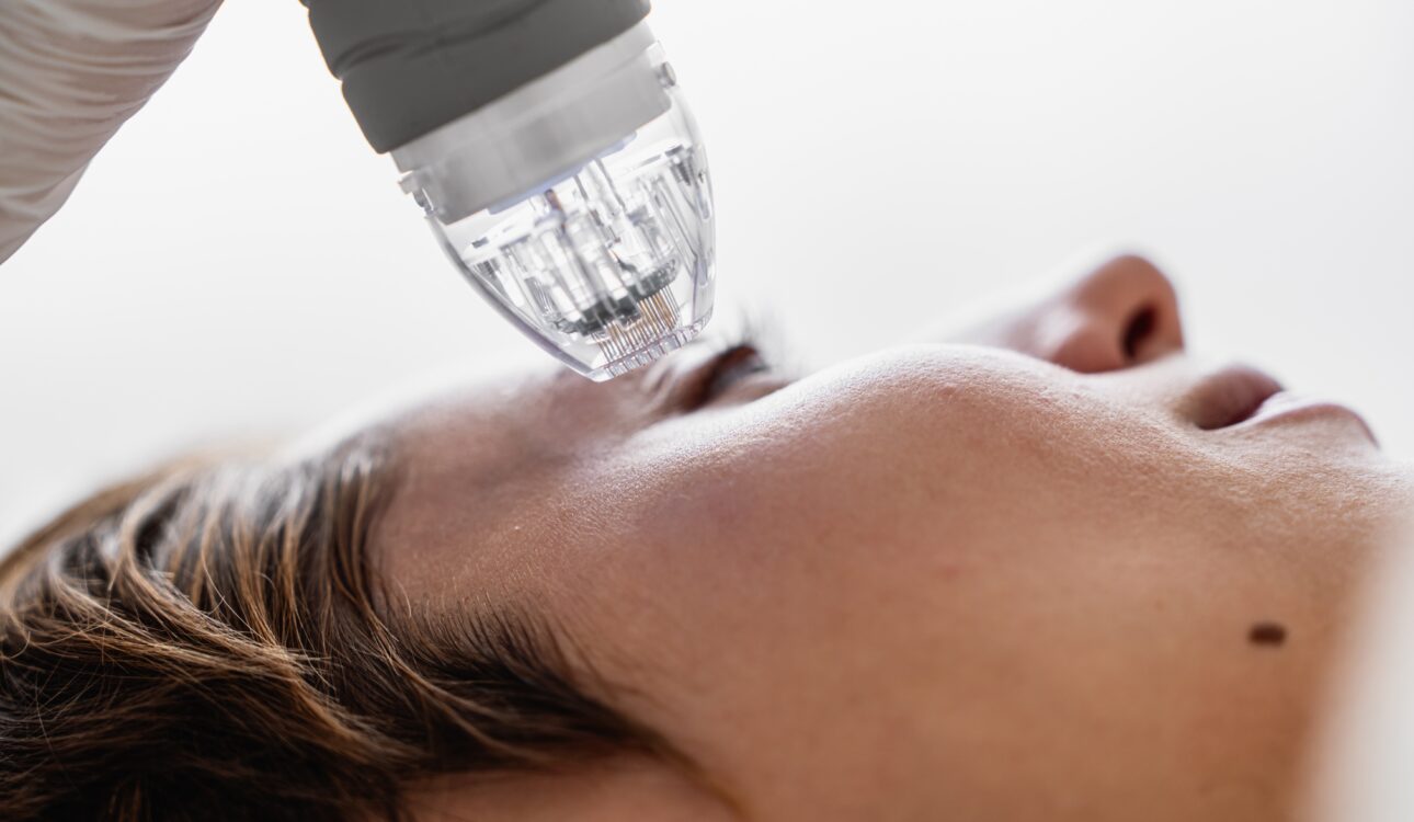 RF Microneedling Sessions for personalized skin treatment