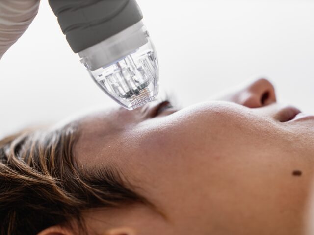 How Many Microneedling Treatments Do You Need to See Results?
